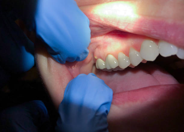 Best Urgent Tooth Repair  in Alum Creek, WV